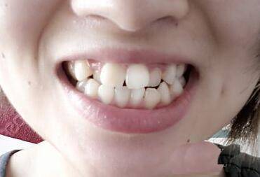 牙齿颗数看面相_杨颖牙齿面相分析_女人的牙齿面相分析