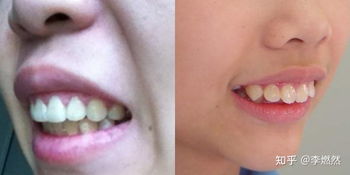 牙齿前凸嘴唇厚_牙齿前凸怎样矫正_牙齿前凸面相
