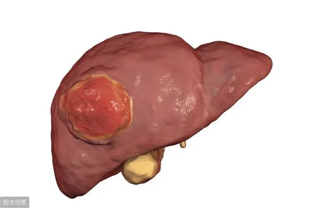 胰腺头癌手术能活多久_八字中怎样看胰腺癌_胃异位胰腺会变癌吗
